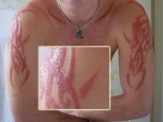 Black henna scars. Picture from ABC news.